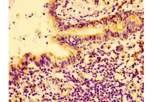 Immunohistochemistry of paraffin-embedded human lung cancer using ABIN7148441 at dilution of 1:100 (CTGF Antikörper  (AA 253-349))