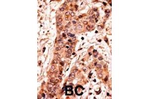 Formalin-fixed and paraffin-embedded human cancer tissue reacted with the primary antibody, which was peroxidase-conjugated to the secondary antibody, followed by AEC staining. (GUCY1A2 Antikörper  (C-Term))