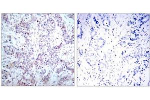 Immunohistochemical analysis of paraffin-embedded human breast carcinoma tissue using NF-κB p65 (Ab-536) antibody (E021014). (NF-kB p65 Antikörper)