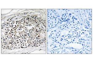 Immunohistochemistry analysis of paraffin-embedded human breast carcinoma tissue using EHHADH antibody. (EHHADH Antikörper  (Internal Region))