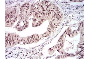 Immunohistochemical analysis of paraffin-embedded rectum cancer tissues using DNMT1 mouse mAb with DAB staining. (DNMT1 Antikörper  (AA 1448-1594))