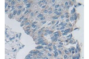 Detection of DSP in Human Prostate cancer Tissue using Polyclonal Antibody to Desmoplakin (DSP)