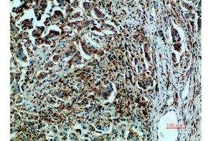 Immunohistochemical analysis of paraffin-embedded human-breast-cancer, antibody was diluted at 1:200 (GRP78 Antikörper  (AA 1268-1341))