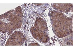 ABIN6277805 at 1/100 staining Human liver cancer tissue by IHC-P. (NCR1 Antikörper  (Internal Region))