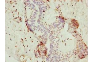 Immunohistochemistry of paraffin-embedded human breast cancer using ABIN7154806 at dilution of 1:100 (rRNA 2'-O-Methyltransferase Fibrillarin (FBL) (AA 1-64) Antikörper)