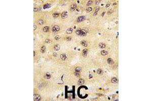 Formalin-fixed and paraffin-embedded human hepatocellular carcinoma tissue reacted with PROX1 polyclonal antibody , which was peroxidase-conjugated to the secondary antibody, followed by DAB staining. (PROX1 Antikörper  (Internal Region))