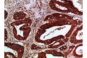 Immunohistochemical analysis of paraffin-embedded human-colon-cancer, antibody was diluted at 1:200 (IKBKG Antikörper  (AA 60-120))