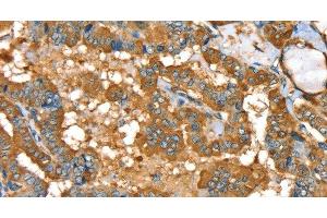 Immunohistochemistry of paraffin-embedded Human thyroid cancer using PYGL Polyclonal Antibody at dilution of 1:35 (PYGL Antikörper)