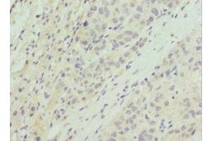 Immunohistochemistry of paraffin-embedded human liver cancer using ABIN7164754 at dilution of 1:100 (PRAS40 Antikörper  (AA 132-256))
