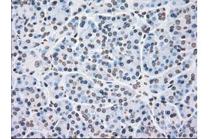 Immunohistochemical staining of paraffin-embedded Adenocarcinoma of colon tissue using anti-PLK1mouse monoclonal antibody. (PLK1 Antikörper)