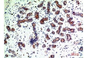 Immunohistochemical analysis of paraffin-embedded human-breast-cancer, antibody was diluted at 1:200 (BMP2 Antikörper  (C-Term))