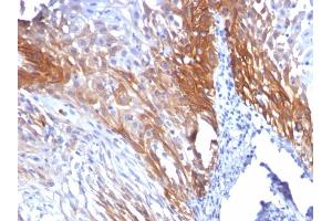 Formalin-fixed, paraffin-embedded human Cervical Carcinoma stained with CK17 Mouse Monoclonal Antibody (KRT17/778). (KRT17 Antikörper)