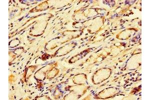 Immunohistochemistry of paraffin-embedded human gastric cancer using ABIN7172505 at dilution of 1:100 (DP2 Antikörper  (AA 344-386))