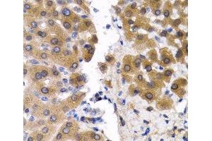 Immunohistochemistry of paraffin-embedded Human liver cancer using SCP2 Polyclonal Antibody at dilution of 1:200 (40x lens). (SCP2 Antikörper)