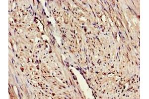 Immunohistochemistry of paraffin-embedded human endometrial cancer using ABIN7151655 at dilution of 1:100 (ERAP1 Antikörper  (AA 642-941))