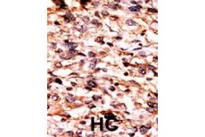 Formalin-fixed and paraffin-embedded human hepatocellular carcinoma tissue reacted with CREB1 (phospho S133) polyclonal antibody  which was peroxidase-conjugated to the secondary antibody followed by AEC staining. (CREB1 Antikörper  (pSer133))