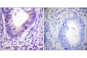 Immunohistochemistry analysis of paraffin-embedded human colon carcinoma tissue, using PKA alpha/beta CAT (Ab-197) Antibody. (PKA alpha/beta Cat (AA 166-215) Antikörper)