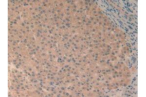 IHC-P analysis of Human Liver Cancer Tissue, with DAB staining. (RELB Antikörper  (AA 248-492))
