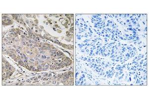 Immunohistochemistry analysis of paraffin-embedded human lung carcinoma tissue using PLA2G4E antibody. (PLA2G4E Antikörper  (Internal Region))