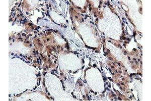 Immunohistochemical staining of paraffin-embedded Carcinoma of Human thyroid tissue using anti-RBBP9 mouse monoclonal antibody. (RBBP9 Antikörper)