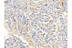 ABIN6260508 and ABIN6268919 at 1/100 staining Human pancreatic cancer and adjacent nomal tissues by IHC-P. (Caveolin-1 Antikörper  (C-Term))