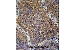 CD2BP2 Antibody (N-term) (ABIN654903 and ABIN2844551) immunohistochemistry analysis in formalin fixed and paraffin embedded human lung carcinoma followed by peroxidase conjugation of the secondary antibody and DAB staining. (CD2BP2 Antikörper  (N-Term))