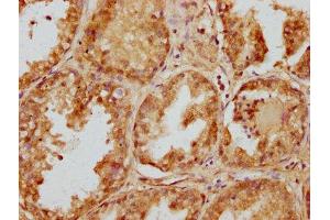 IHC image of ABIN7151970 diluted at 1:200 and staining in paraffin-embedded human prostate cancer performed on a Leica BondTM system.