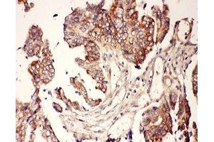 IHC-P: CNTF antibody testing of human intestine cancer tissue (CNTF Antikörper  (AA 2-200))