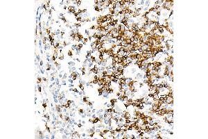 Immunohistochemistry of paraffin-embedded Human Hodgkin lymphoma using IGHD antibody (ABIN7267824) at dilution of 1:100 (40x lens). (IgD Antikörper)