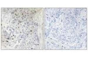 Immunohistochemistry analysis of paraffin-embedded human breast carcinoma tissue, using MAFF antibody. (MafF Antikörper)