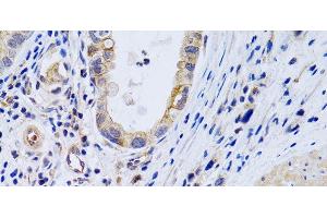 Immunohistochemistry of paraffin-embedded Human gastric cancer using PTGIR Polyclonal Antibody at dilution of 1:200 (40x lens). (Prostacyclin Receptor Antikörper)