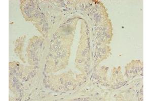 Immunohistochemistry of paraffin-embedded human prostate cancer using ABIN7166819 at dilution of 1:100 (C11ORF45 Antikörper  (AA 23-145))