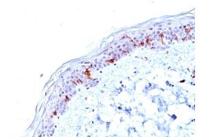 Formalin-fixed, paraffin-embedded human Skin stained with CD1a Mouse Monoclonal Antibody (O10). (CD1a Antikörper)