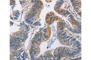 Immunohistochemistry of Human colon cancer using PGK1 Polyclonal Antibody at dilution of 1:50