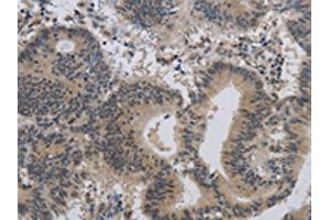 The image on the left is immunohistochemistry of paraffin-embedded Human colon cancer tissue using ABIN7189784(ALX4 Antibody) at dilution 1/20, on the right is treated with synthetic peptide. (ALX4 Antikörper)