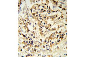 FGFR1 Antibody i IHC analysis in formalin fixed and paraffin embedded human breast carcinoma followed by peroxidase conjugation of the secondary antibody and DAB staining. (FGFR1 Antikörper)