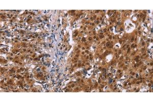 Immunohistochemistry of paraffin-embedded Human gastic cancer using CBX3 Polyclonal Antibody at dilution of 1:40 (CBX3 Antikörper)