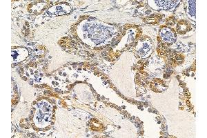 ABIN7093923 and ABIN7097967 at 1/100 staining human ovarian cancer by IHC-P. (NCS1 Antikörper  (C-Term))