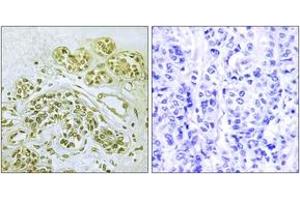 Immunohistochemistry analysis of paraffin-embedded human breast carcinoma, using IkappaB-alpha (Phospho-Tyr42) Antibody. (NFKBIA Antikörper  (pTyr42))