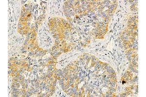 SDF4 Mouse Monoclonal Antibody at 1/100 staining human lung cancer by IHC-P. (SDF4 Antikörper)