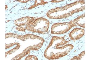 Formalin-fixed, paraffin-embedded human Prostate Carcinoma stained with YBX1 Mouse Monoclonal Antibody (YBX1/2430) (YBX1 Antikörper)