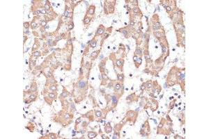 Immunohistochemistry of paraffin-embedded Human liver cancer using ATP5A1 Polyclonal Antibody at dilution of 1:100 (40x lens). (ATP5A1 Antikörper)