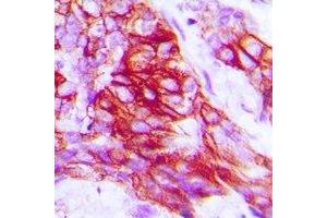 Immunohistochemical analysis of Syntaxin 1A (pS14) staining in human prostate cancer formalin fixed paraffin embedded tissue section. (STX1A Antikörper  (N-Term, pSer14))