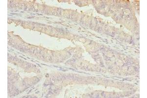 Immunohistochemistry of paraffin-embedded human endometrial cancer using ABIN7145239 at dilution of 1:100 (BBS2 Antikörper  (AA 1-96))