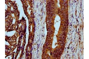 IHC image of ABIN7158674 diluted at 1:300 and staining in paraffin-embedded human colon cancer performed on a Leica BondTM system. (LYRM4 Antikörper  (AA 1-91))