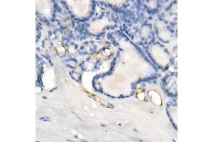 Immunohistochemistry of paraffin-embedded human thyroid cancer using eNOS Rabbit mAb (ABIN7268920) at dilution of 1:200 (40x lens).