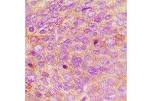 Immunohistochemical analysis of Defensin alpha 1 staining in human breast cancer formalin fixed paraffin embedded tissue section. (alpha Defensin 1 Antikörper  (Center))