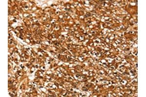 The image on the left is immunohistochemistry of paraffin-embedded Human prostate cancer tissue using ABIN7192401(SLC16A3 Antibody) at dilution 1/30, on the right is treated with synthetic peptide. (SLC16A3 Antikörper)