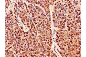 Immunohistochemistry of paraffin-embedded human ovarian cancer using ABIN7162945 at dilution of 1:100 (Peroxiredoxin 6 Antikörper  (AA 87-224))