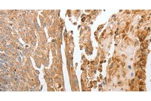 Immunohistochemistry of paraffin-embedded Human cervical cancer using NPY1R Polyclonal Antibody at dilution of 1:30 (NPY1R Antikörper)